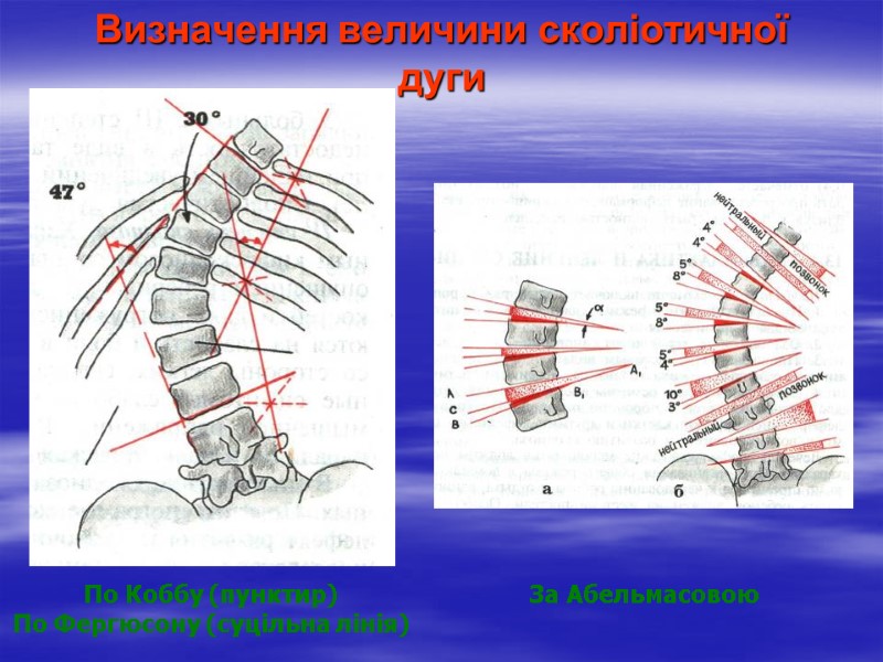 Визначення величини сколіотичної дуги По Коббу (пунктир) По Фергюсону (суцільна лінія) За Абельмасовою
